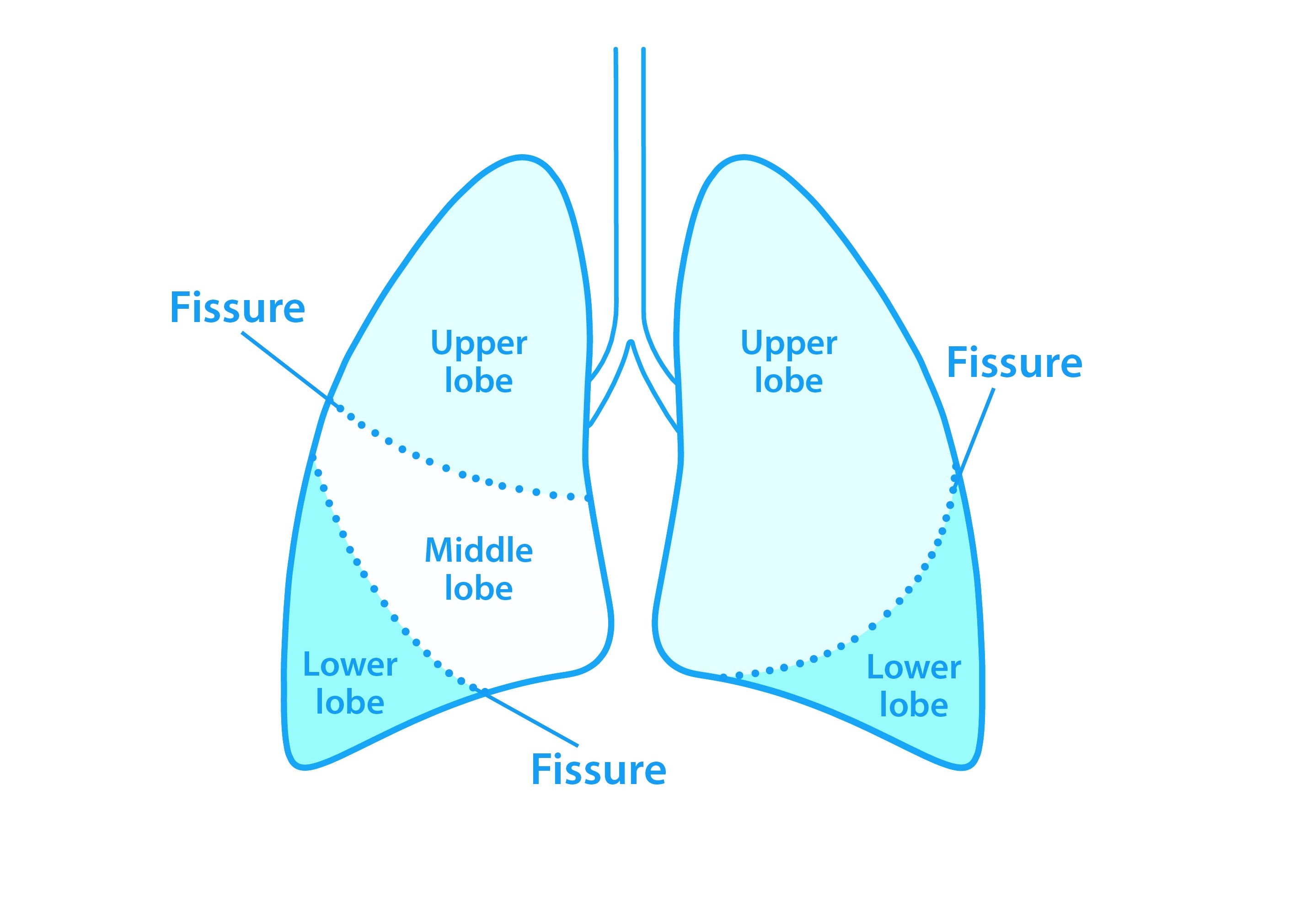Lung volume reduction procedures Asthma + Lung UK